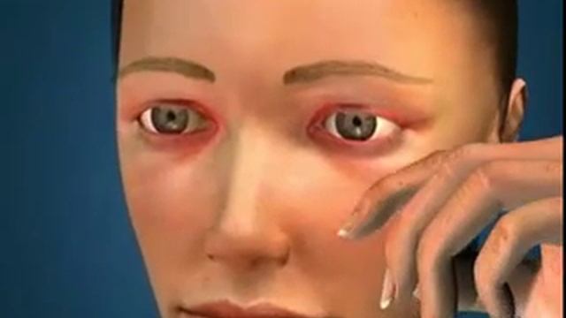 Блефарит смотреть онлайн