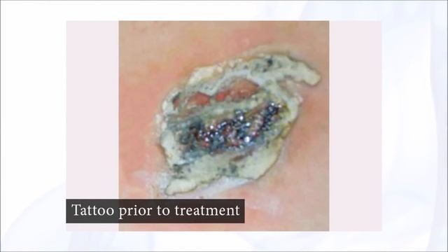 Rejuvi tattoo remover before and after смотреть онлайн