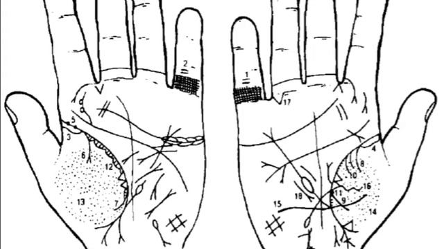 23. Стояновский Д.Н. Диагностика заболеваний по кожным рисункам ладони смотреть онлайн