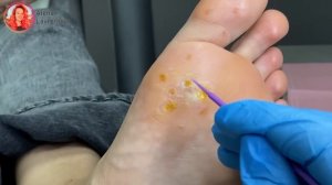 Сложный случай с бородавками / Бородавка на стопе / Бородавки