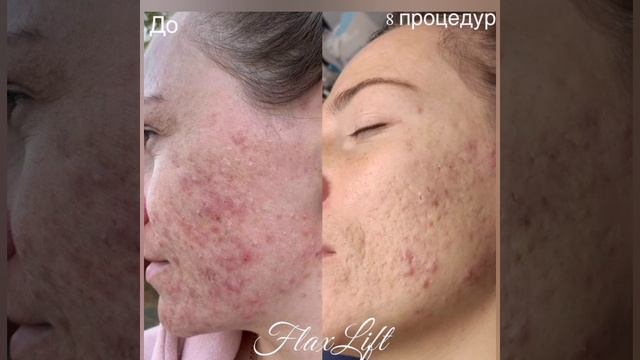 Что такое FlaxLift? ?