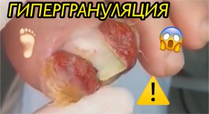 Гипергрануляция ???⚠️