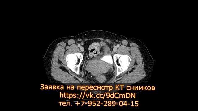 Расшифровка КТ брюшной полости показала гидронефроз и стеноз смотреть онлайн