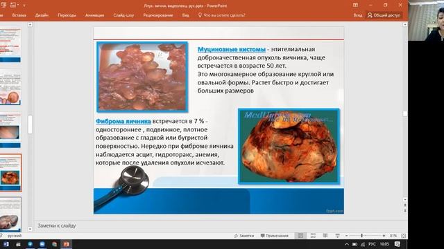 Опухоли яичников