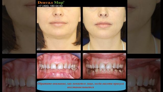 Стираемость, Ортотик, Сплинт