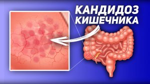 Как Избавиться от Кандиды в Кишечнике / Лечение кандидоза кишечника