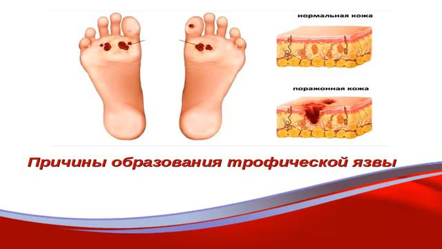 # My Gem4me 21 12 16 Gem4me Bio Трофические язвы при сахарном диабете, венозной недостаточно