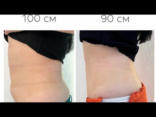 - 10см за 20 дней. Как быстро и безопасно похудеть. #липомодулятор Lipo Long #липолитик