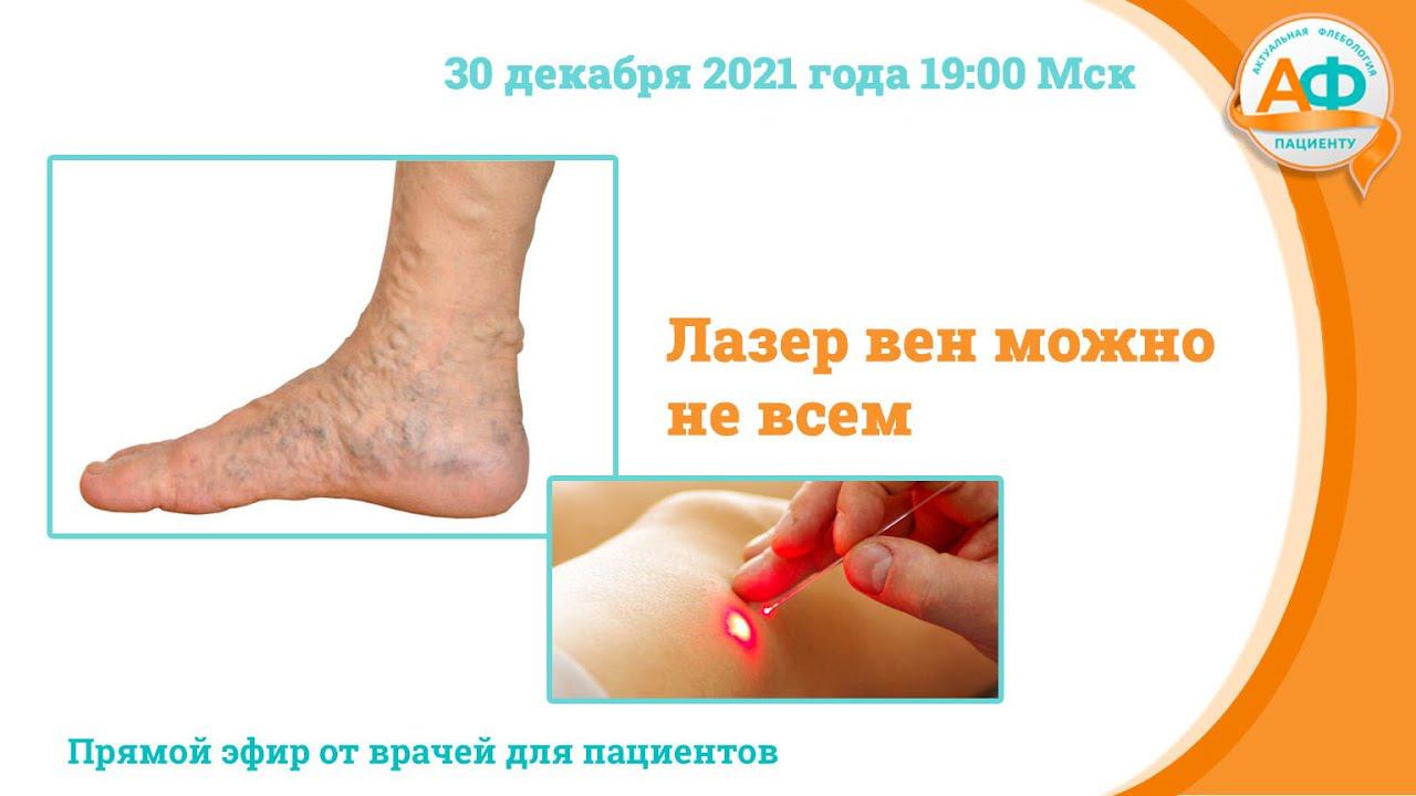 Лазер вен можно не всем смотреть онлайн