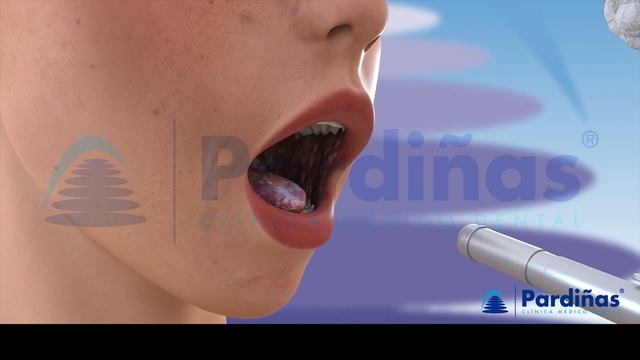 ORAL THRUSH - Candidiasis or yeast infection. Angular cheilitis © смотреть онлайн