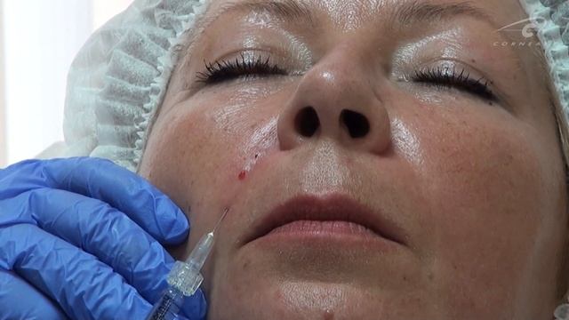 Корректируем залом носогубной складки Princess Filler смотреть онлайн