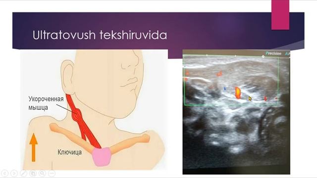 Bolalarda Bo'yin Qiyshiqligi (кривошея). Кривошея.