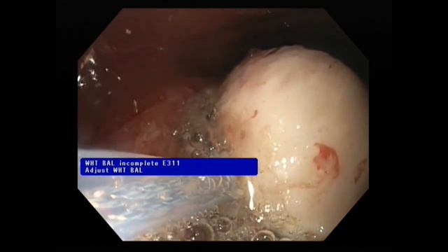 Лейомиома ДПК - завершенная версия