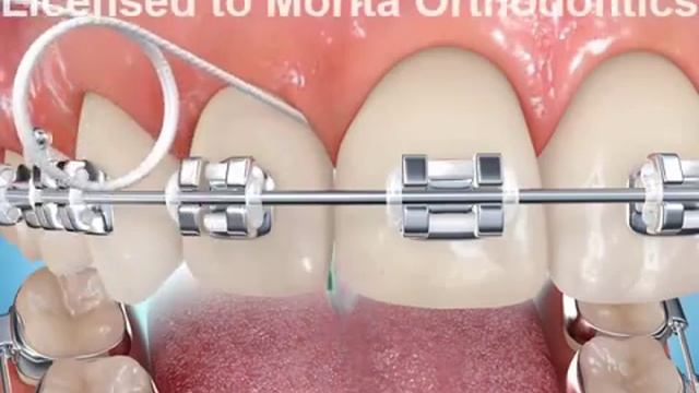 Superfloss with Braces смотреть онлайн