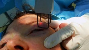 Лазерная шлифовка верхних и нижних век