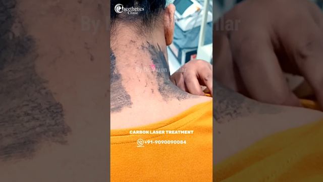 Neck Carbon Peel Laser Treatments | Hollywood Carbon Peel | Facthetics Clinic | смотреть онлайн