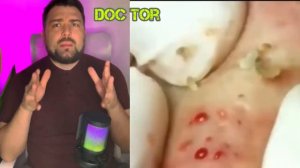 Почему нельзя выдавливать прыщи? 😱Подробный разбор🫣