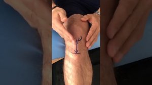 Тендинит собственной связки надколенника (Колено прыгуна)