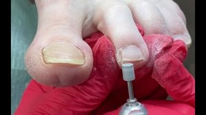 ?ПЕДИКЮР? Убираю длину и толщину ногтей фрезой цилиндр ??