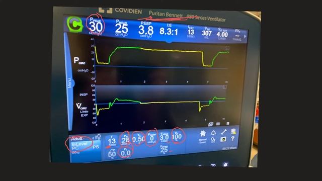 Demonstrating Airway Pressure Release Ventilation (APRV) Mode On The Ventilator Screen