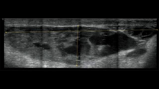 Гигантская многокамерная киста Беккера