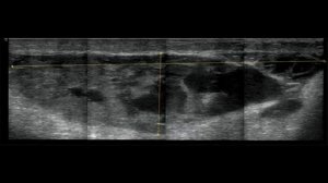 Гигантская многокамерная киста Беккера