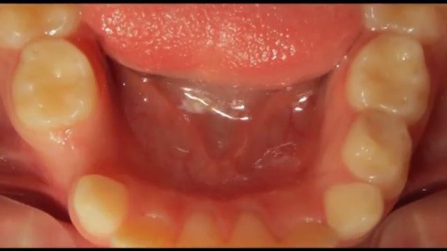 неправильный прикус. исправление прикуса. Трейнеры смотреть онлайн