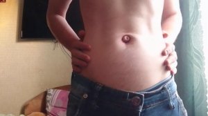 Navel outie hernia