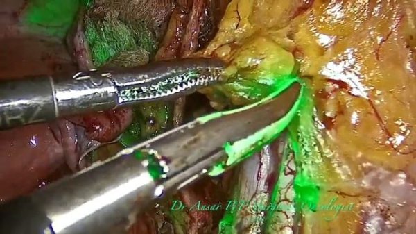 laparoscopic sentinel node biopsy for carcinoma endometrium
