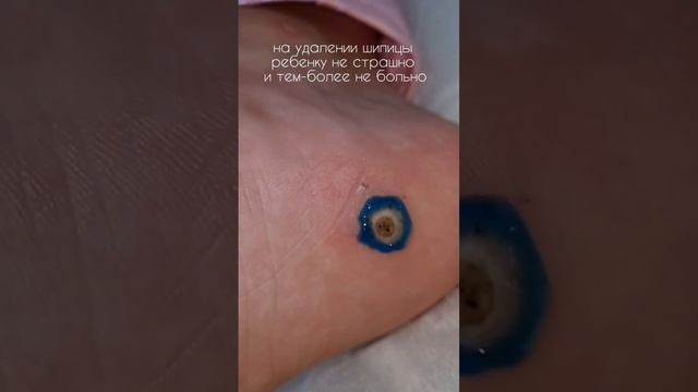 #ШИПИЦА У ДЕВОЧКИ РУСАЛКИ #подология