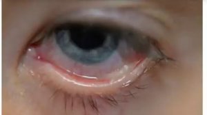 ВОТ почему по утрам в уголках ГЛАЗ появляется засохшая слизь!!