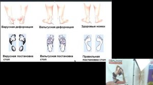 ✅ ТЕЙПИРОВАНИЕ ПРИ ВАЛЬГУСНОЙ СТОПЕ У ДЕТЕЙ | Наталья Суворова | Учебный центр BBALANCE