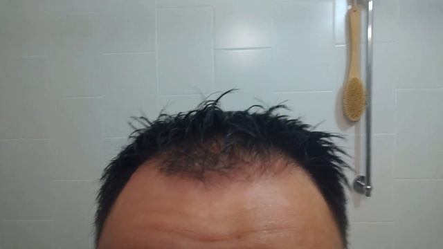 Микронидлинг & эфирные масла против выпадения волос / Microneedling & essential oils Anti Hair Los смотреть онлайн