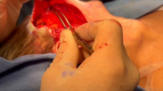 Techniques on Working in the Deep Plane during an Extended Deep Plane Facelift смотреть онлайн