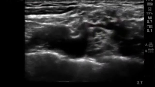 надключичная блокада плечевого сплетения под контролем ультразвуковой визуализации смотреть онлайн