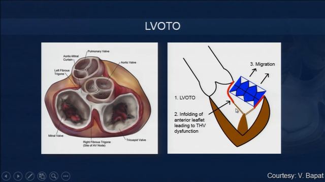 Trans-catheter Mitral VNV and Valve in Ring: The New Standard (Gilbert Tang, MD) смотреть онлайн