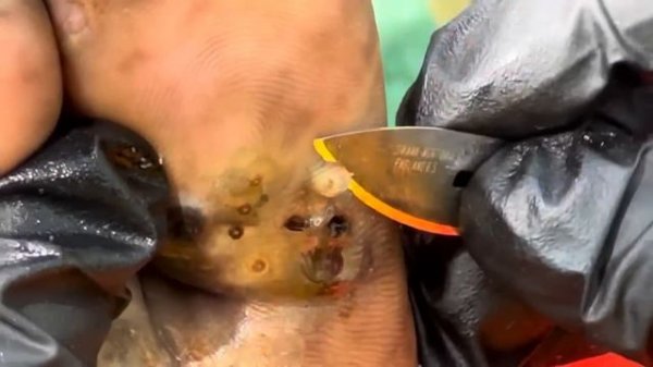 Charles’s very last jigger digging - WORST ATTACK EVER, watch full video @riseupsociety.net