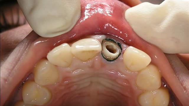 Сломался зуб. Что делать. Протезирование г. Сумы..wmv смотреть онлайн