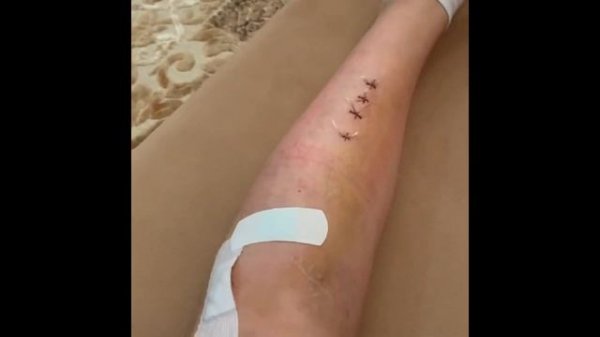 Удаление пластины, остеосинтез голени, перелом большеберцовой кости