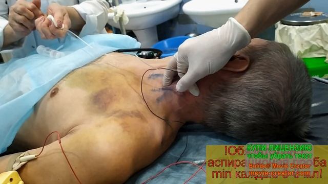 Межлестничная блокада плечевого сплетения смотреть онлайн