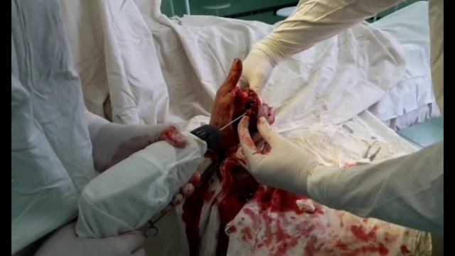 Блок плечевого сплетения по Куленкампфу. Brachial plexus block paresthesia technique смотреть онлайн