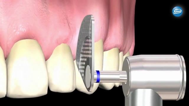 Осциллирующая интерпроксимальная редукция эмали с использованием OS дисков и наконечника OS30 смотреть онлайн