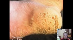 Проверка на Трипофобию(боязнь скопления отверстий)