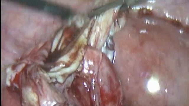 Удаление эндометриодной кисты яичника смотреть онлайн