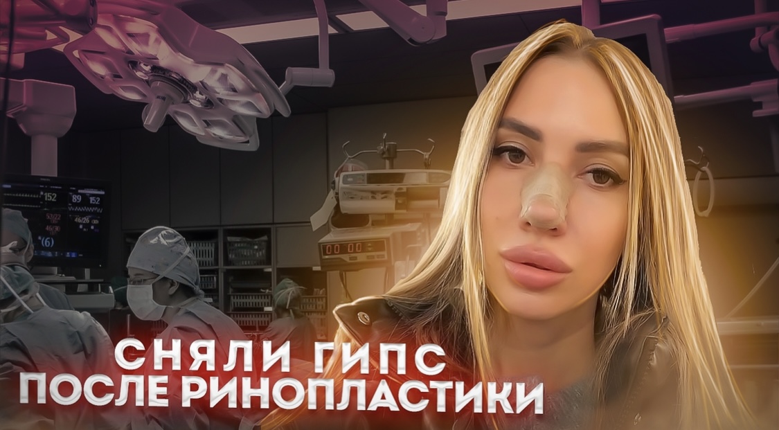 Сняли гипс после ринопластики. Ринопластика. Операция на нос . Фотосессия. Отзывы о клинике смотреть онлайн