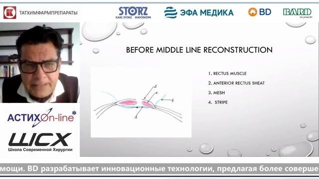 Сметанский. "Stripe bounding" техника при больших грыжах белой линии живота. смотреть онлайн
