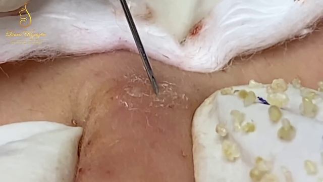 Removal whiteheads and blackheads (262) Loan Nguyen смотреть онлайн