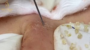 Removal whiteheads and blackheads (262) Loan Nguyen