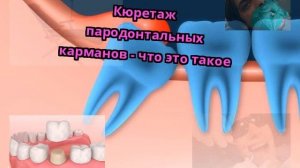 Кюретаж пародонтальных карманов - что это такое
