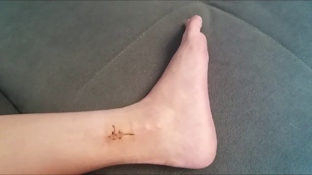 Двухлодыжечный перелом со смещением. УДАЛЕНИЕ ПОЗИЦИОННОГО ВИНТА. смотреть онлайн